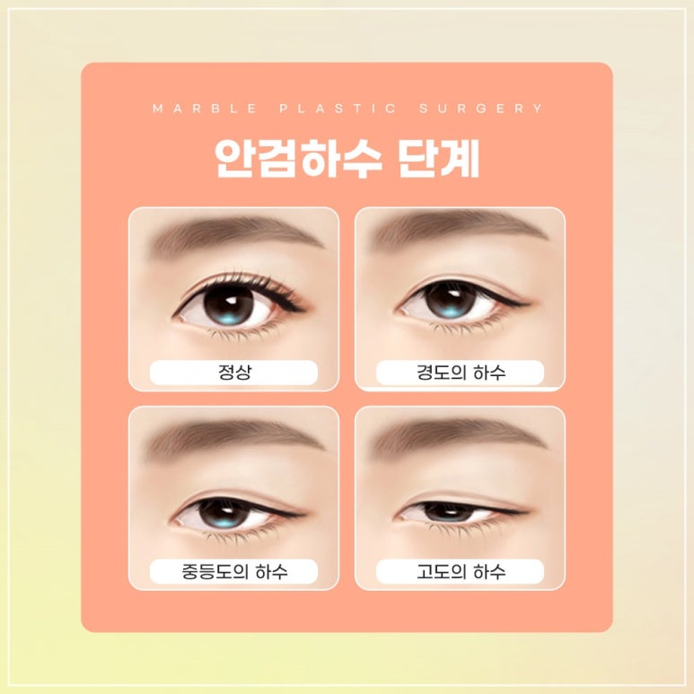 강남역 고등학생눈매교정잘하는곳, 시술방법, 장점, 필요성 관련 이미지 5