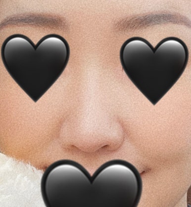 [Gangnam Plastic Surgery Rhinoplasty Review] I Was Worried About My Bulbous Nose.. It Turned Out Beautiful While Healing Well Without Inflammation or Side Effects hehe image 4