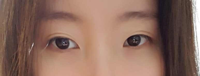 눈커지는수술 매력적인 모습으로 관련 이미지 3