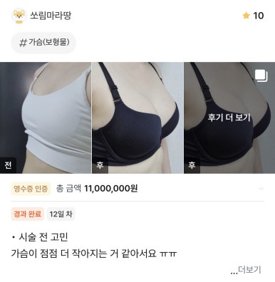 [강남역 성형외과 가슴수술 후기] 운동으로 실종됐던 가슴ㅠㅠ 서일범 원장님 덕분에 인생 바디라인 완성! 관련 이미지 1
