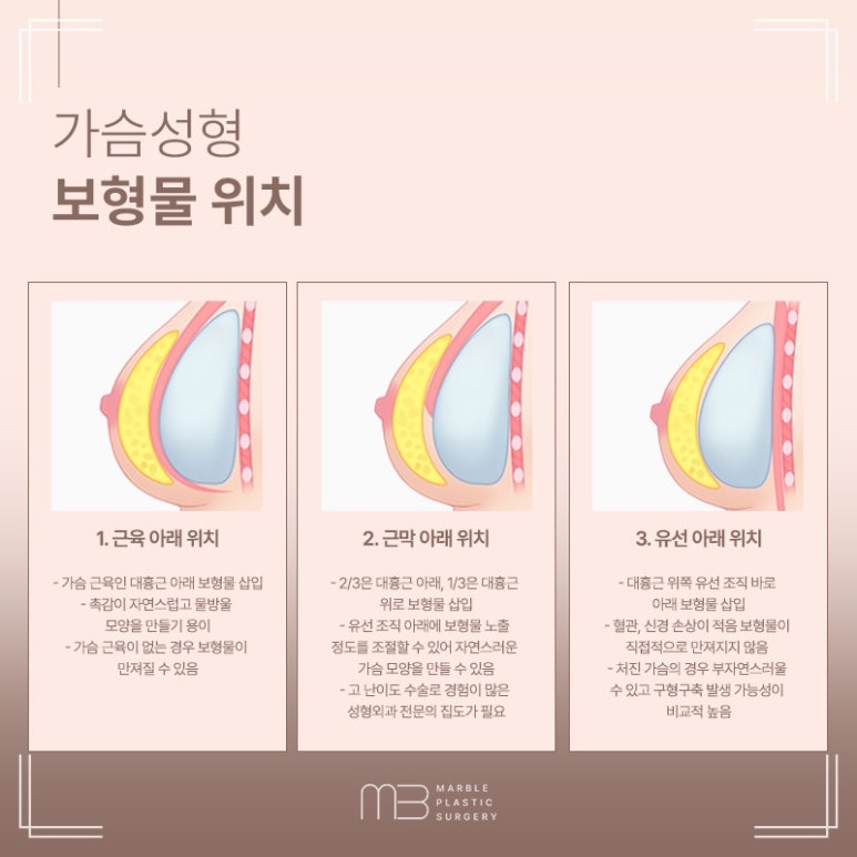 가슴성형흉터 절개 위치별 특징 비교｜마블성형외과 관련 이미지 6