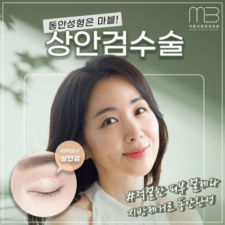 중년눈성형의 필요성과 효과 관련 이미지 1