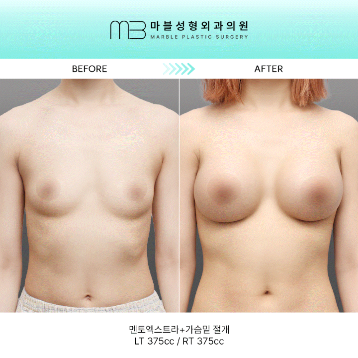 [멘토 가슴수술] 가슴성형 5개월 차: 멘토엑스트라로 완성하는 워너비 라인의 정석 관련 이미지 1