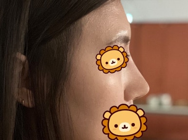 [강남성형외과 복코성형 후기] 각도 안 나오던 펑퍼짐한 코 모양.. 김준형 원장님 만나 정착했어요! 관련 이미지 6
