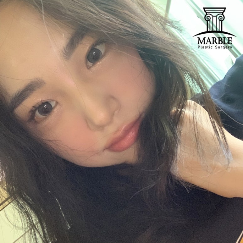 눈매교정 해야 하는 눈일까? 마블성형외과의원에서 알아보자! 관련 이미지 2