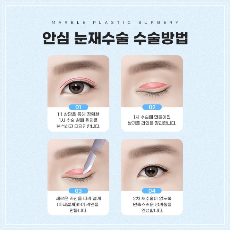 쌍수재수술잘하는곳 비용보다 원인분석이 중요 관련 이미지 3