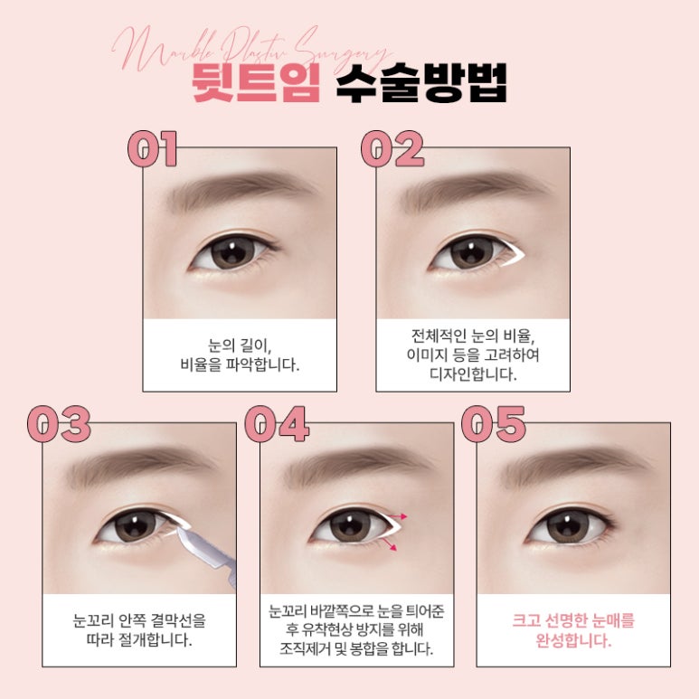 뒤트임흉터 남지 않도록 첫 수술시 의료진 상담 철저히 관련 이미지 4