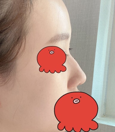 [강남성형외과 매부리코성형 후기] 부작용만 찾다가,, 금손 원장님 만나 코 정착했어요! 관련 이미지 3