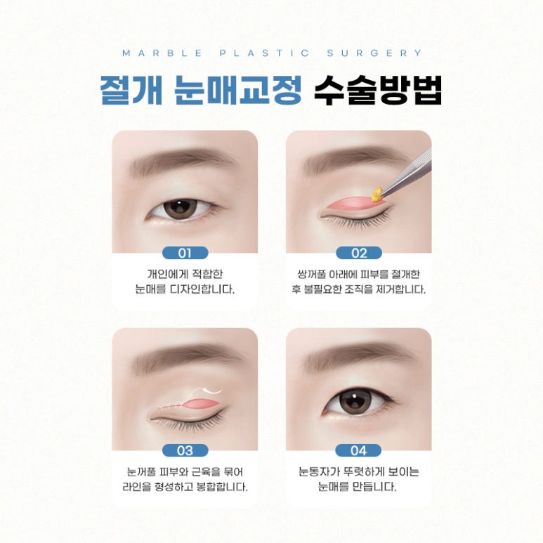 강남눈매교정 더 또렷하게 마블성형외과의원 관련 이미지 7