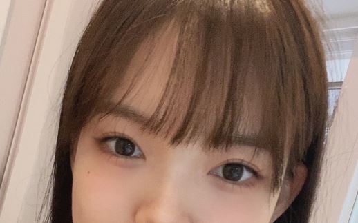 쌍수 붓기시간 수술법에 따라 다르다? 관련 이미지 4