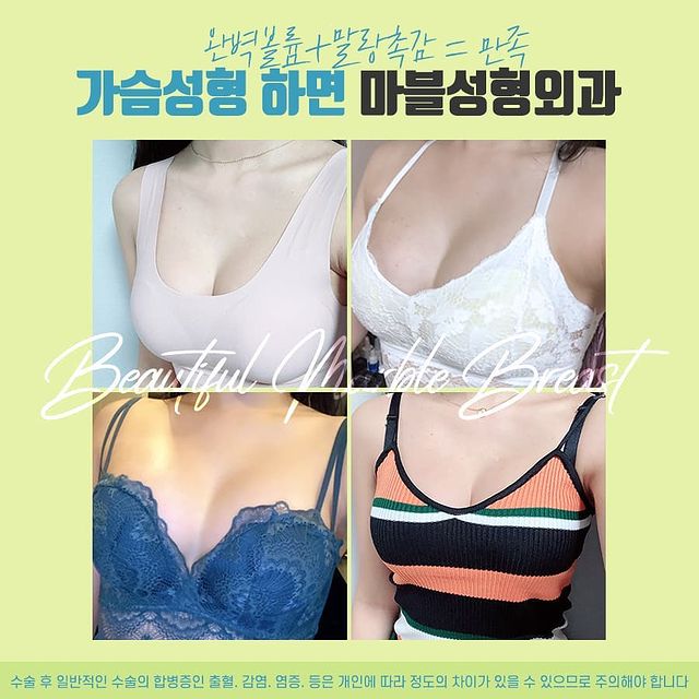 가슴성형주의사항 보정브라와 윗밴드 언제까지? 관련 이미지 10