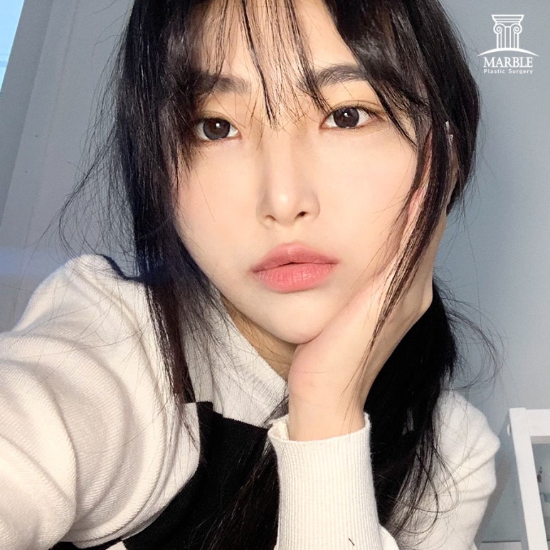 쌍꺼풀매몰후기 찾아보고 있다면 관련 이미지 1