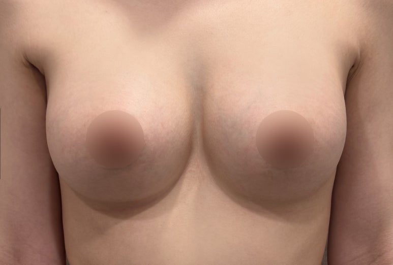 가슴수술 후 불편함, 부작용 때문일까요? 가슴재수술 전 확인 포인트 관련 이미지 5