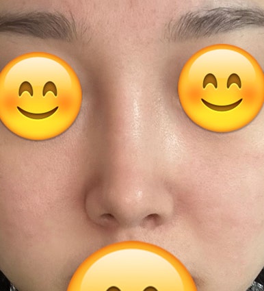 [강남역성형외과 복코성형 후기] 지인들도 부러워하는 매끄러운 코라인, 원장님 덕에 거울 볼 때마다 뿌듯해요 관련 이미지 7