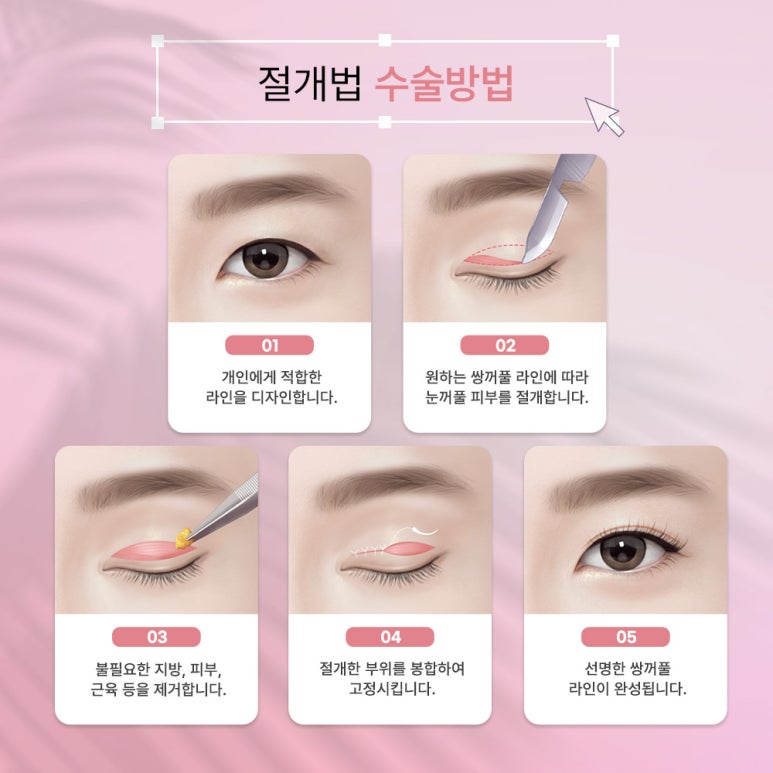 쌍수절개 좋은 선택을 하는 방법 관련 이미지 5