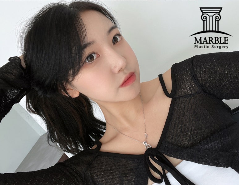 쌍꺼풀수술비용, 합리적인 변화는 마블성형외과의원! 관련 이미지 6