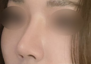 [강남성형외과 매부리코성형 후기] 필러 변형에 점점 이상해지는 콧대.. 필러제거 후 인생 코 정착 완료! 관련 이미지 8
