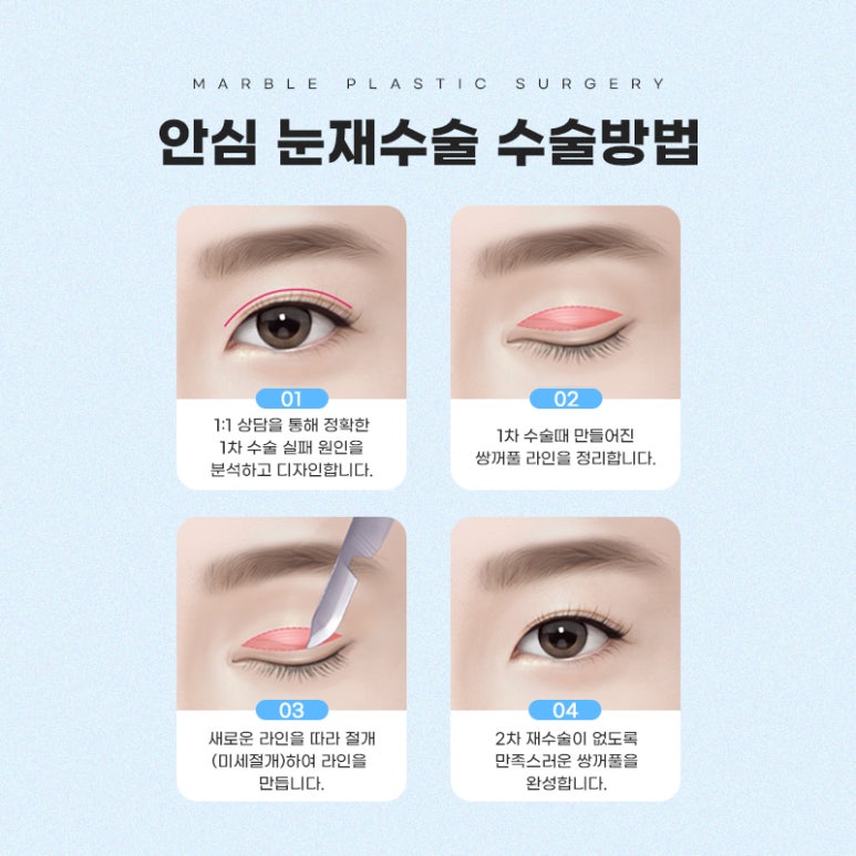 눈재수술잘하는곳 새로운 시작을 위해 관련 이미지 3