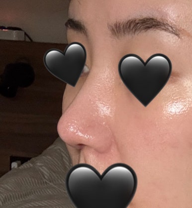 [Gangnam Plastic Surgery Rhinoplasty Review] I Was Worried About My Bulbous Nose.. It Turned Out Beautiful While Healing Well Without Inflammation or Side Effects hehe image 9