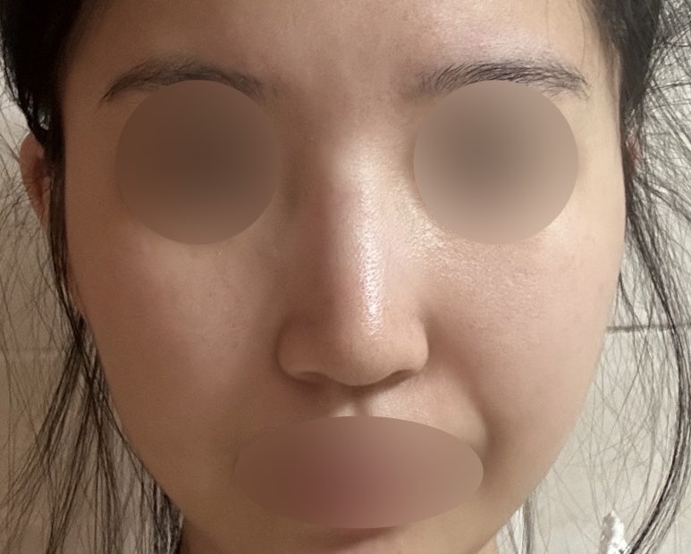 서초구 코수술 잘하는곳 마블성형외과에서 예쁜 코라인으로 변화 관련 이미지 1