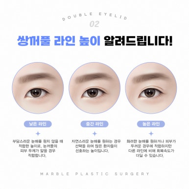 쌍수매몰 이미지 개선을 위해! 마블성형외과 관련 이미지 9