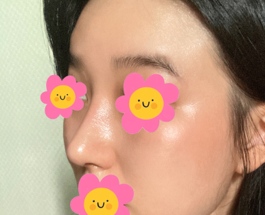 [Marble Plastic Surgery Nose Surgery Review] I Kept Worrying About My Hump Nose... I Should Have Had Surgery Sooner image 6