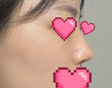 [매부리코수술 후기] 뭉툭한 코끝에 매부리가 고민이었는데..조금이라도 빨리할걸 아쉽네요ㅠㅠ 관련 이미지 5