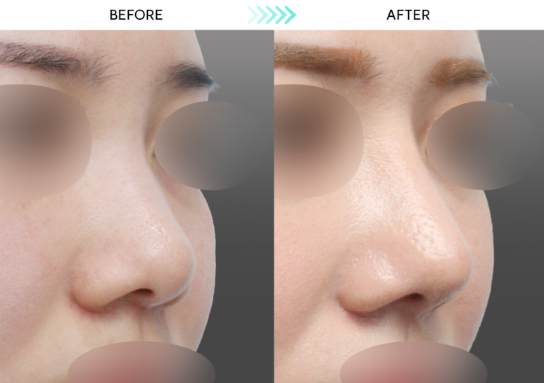 [Revision Rhinoplasty] 5 Months After Short Nose Correction: The Standard Approach to Bulbous Nose Correction and Alar Reduction image 2