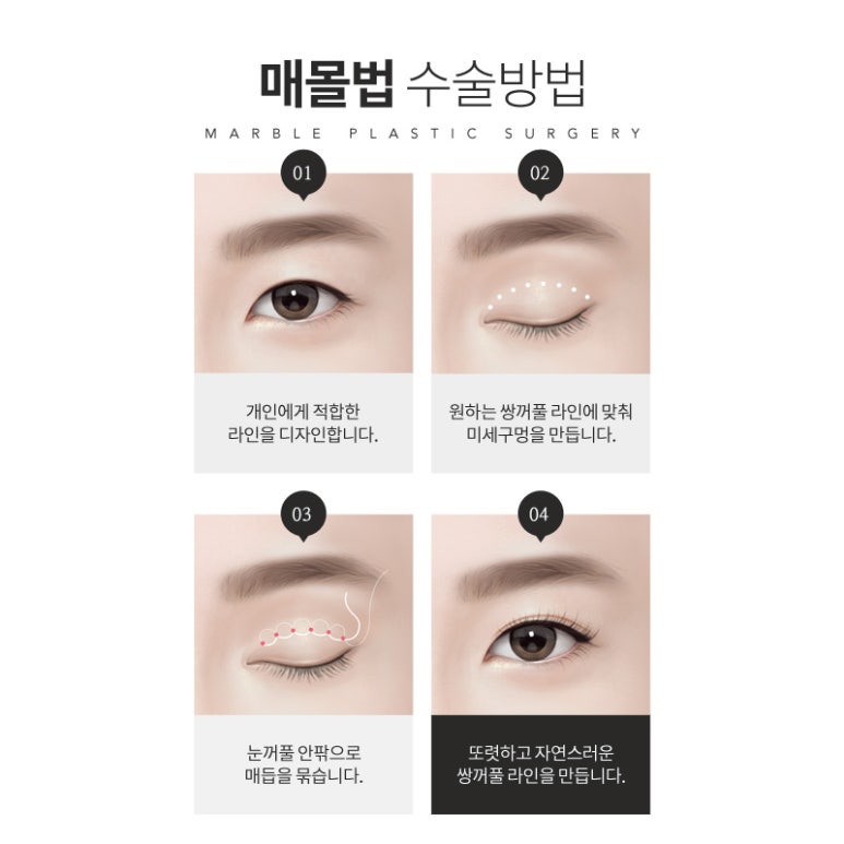 쌍커풀잘하는곳 찐으로 알아보세요 관련 이미지 6
