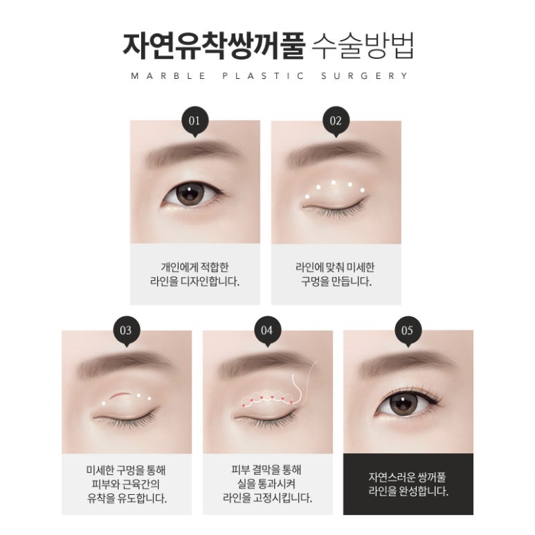 자연유착 흉터 붓기 최소화 지향한 내추럴한 쌍꺼풀 관련 이미지 8