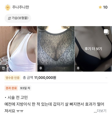 [강남성형외과 가슴수술 후기] 가슴은 역시 보형물이 정답이네요.. 빠진 지방이식에서 꽉 찬 볼륨 핏 완성! 관련 이미지 1
