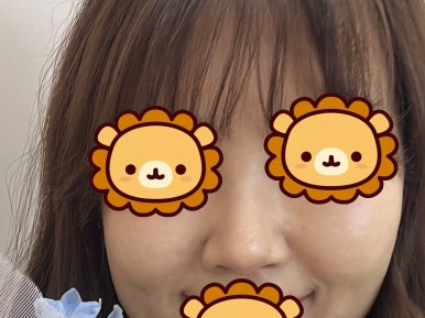 [강남성형외과 복코성형 후기] 각도 안 나오던 펑퍼짐한 코 모양.. 김준형 원장님 만나 정착했어요! 관련 이미지 4