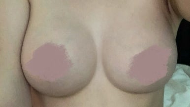 가슴재수술, 실패를 줄이기 위한 기준은? 관련 이미지 12