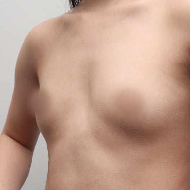 [강남역 성형외과 가슴성형 후기] 빈약한 윗가슴 콤플렉스..짝가슴도 맞춰졌고 촉감까지 완전 찐가슴이에요! 관련 이미지 5