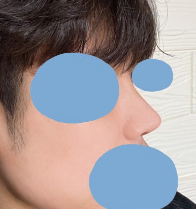 [Gangnam Plastic Surgery Male Nose Surgery Review] After tidying up the hump and bulbous nose that made me look stuffy, my T-zone and facial features looked completely alive! image 5