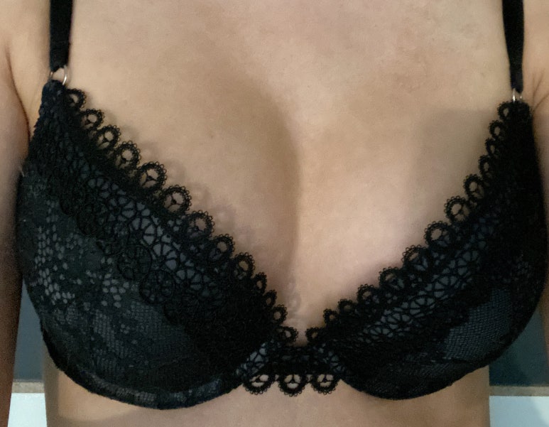 가슴확대수술 첫 수술, 어떤 기준으로 결정해야 할까요? 관련 이미지 2