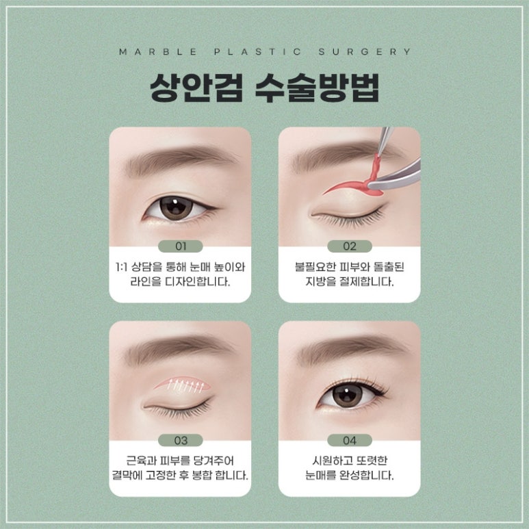중년눈성형의 필요성과 효과 관련 이미지 4