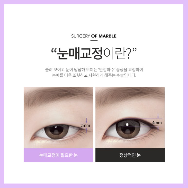 안검하수 처진눈 교정으로 또렷한 눈매를! 관련 이미지 4