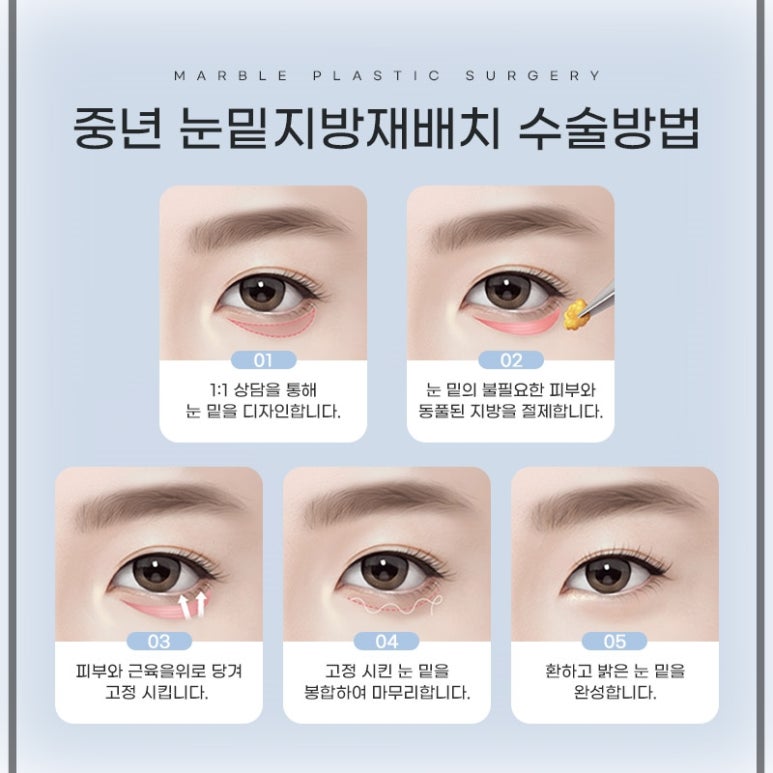 눈밑지방재배치수술비용 꼭 알아야 할 기준은?｜마블성형외과의원 관련 이미지 10
