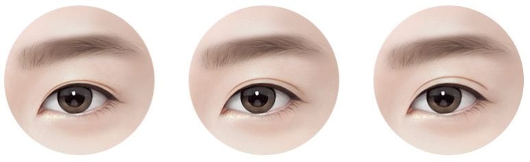 쌍수라인 실밥제거후 두갈래로 잡힌 경우 마블성형외과의원 관련 이미지 6