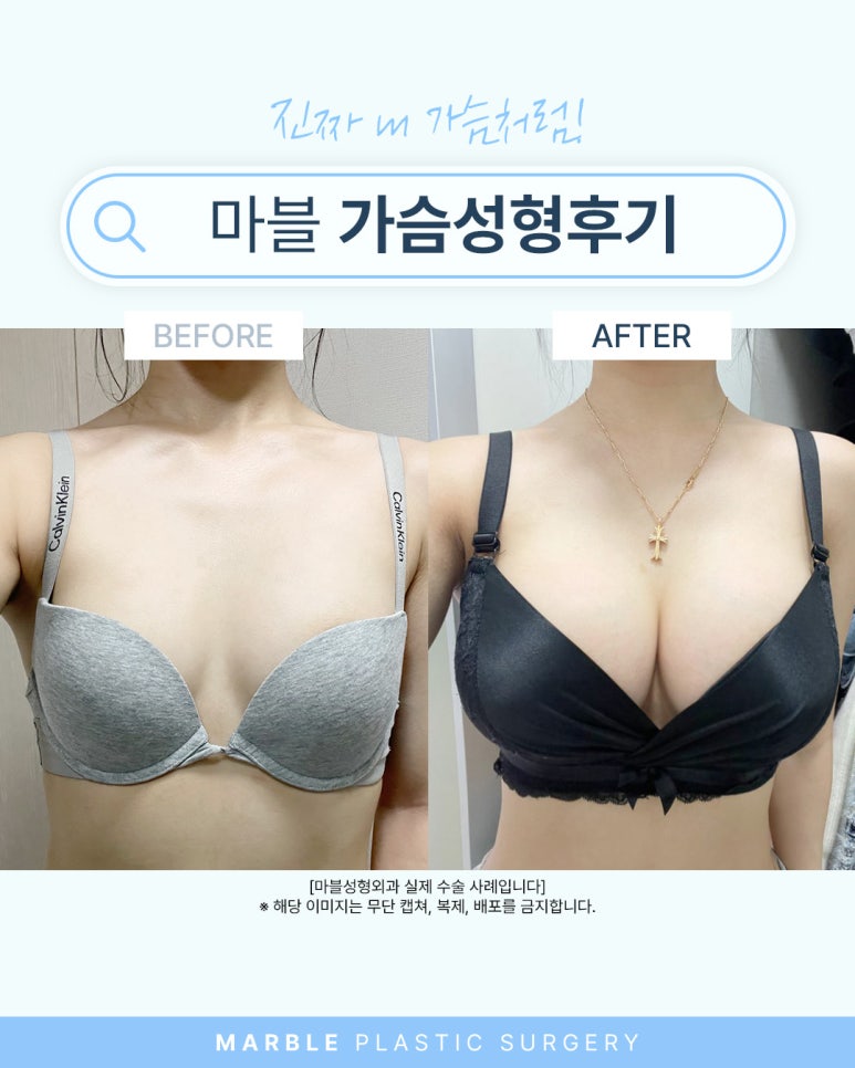 가슴 보형물 선택 기준은? 관련 이미지 2