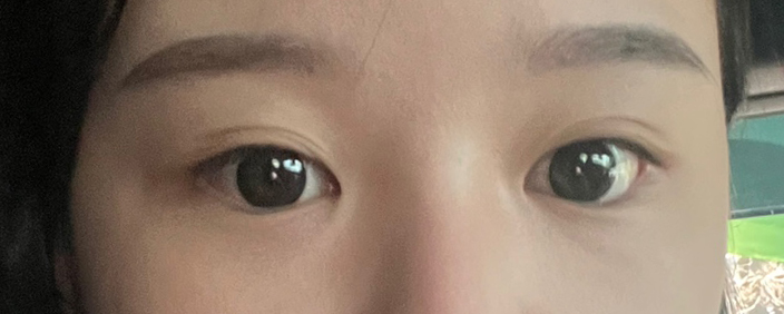 눈성형 개인별 맞춤 수술 방법 관련 이미지 2