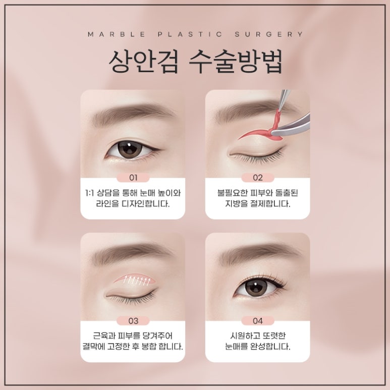 My Real Self-Paid Review of Treating My Parents to a So-Called Filial Surgery with Upper Blepharoplasty for Middle-Aged Eyes image 4