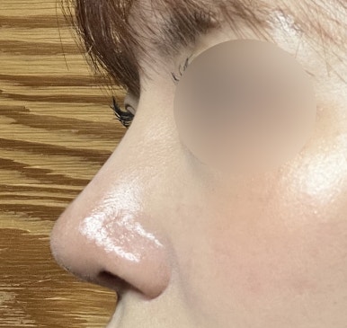 [강남성형외과 복코수술 후기] 사진 찍기 두렵던 뭉툭한 코.. 김준형원장님 만나고 세련된 라인이 됐어요! 관련 이미지 5