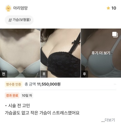[강남역 성형외과 가슴수술 후기] 옷태 안 살던 빈약한 가슴ㅠㅠ 자연스러운 볼륨 생기고 고민 해결! 관련 이미지 1