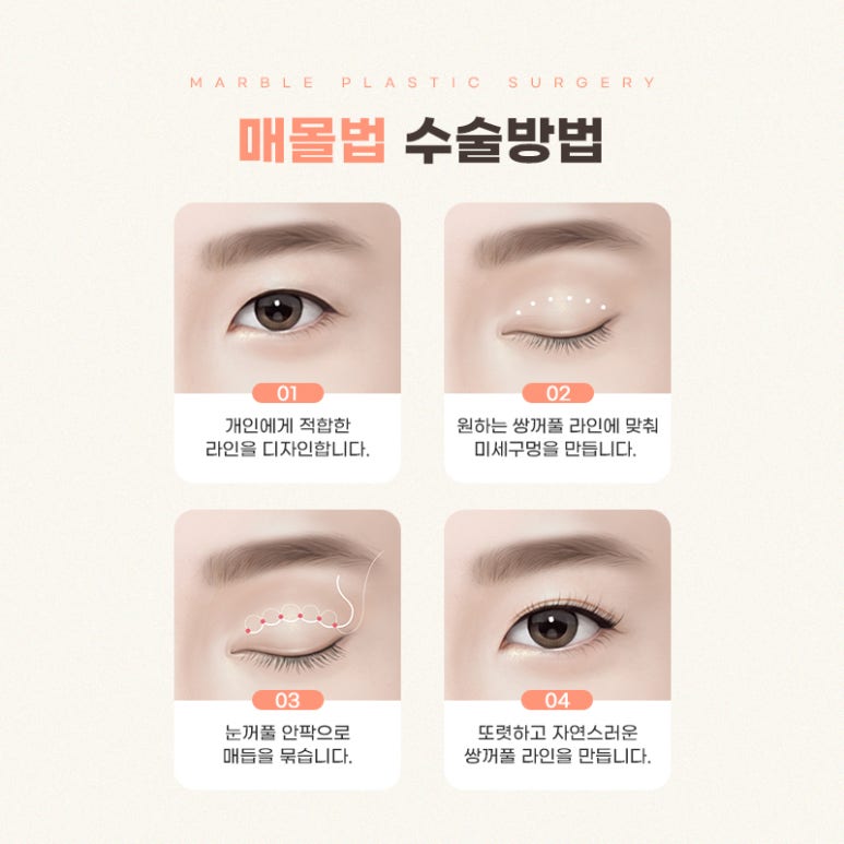 쌍수매몰 알아야 할 사실들 마블성형외과의원 관련 이미지 5