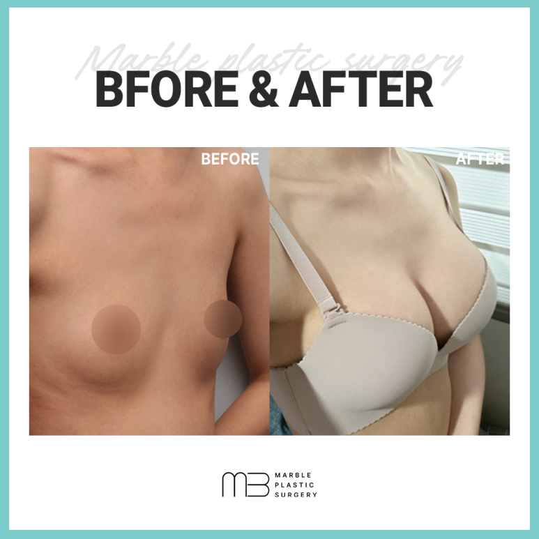 가슴 보형물, 모양 촉감 차이 왜 이렇게 다를까요? 관련 이미지 3
