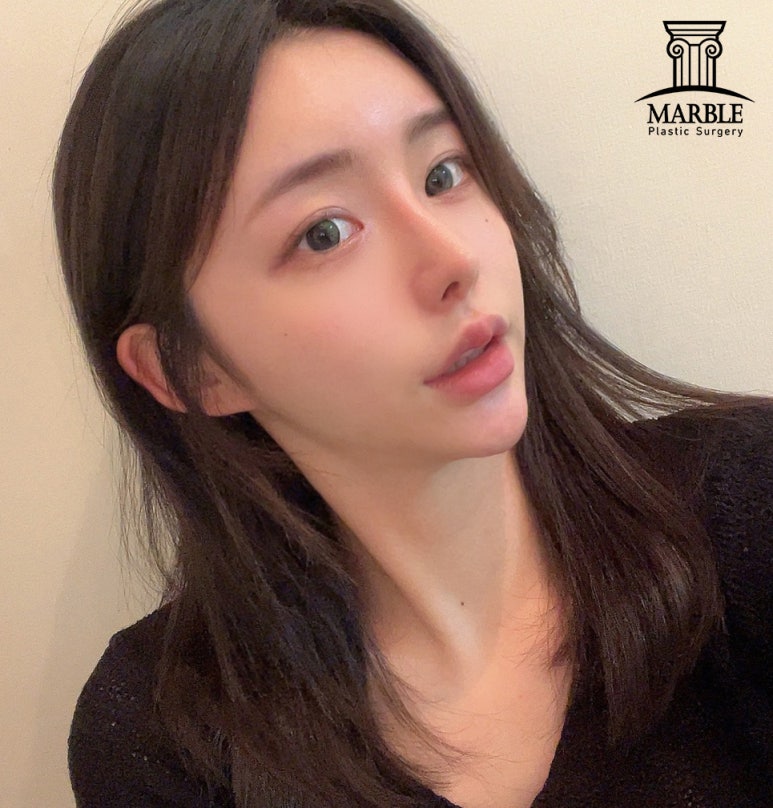 눈재수술, 반복되지 않으려면 마블성형외과의원에서! 관련 이미지 2
