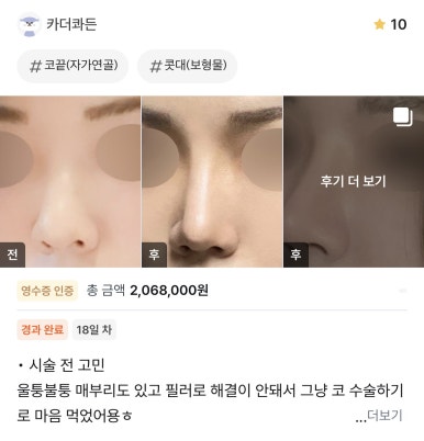 [강남성형외과 매부리코성형 후기] 필러 변형에 점점 이상해지는 콧대.. 필러제거 후 인생 코 정착 완료! 관련 이미지 1