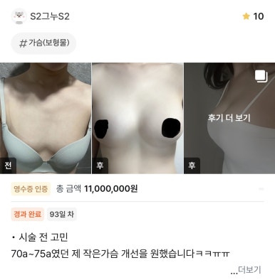 [강남성형외과 가슴확대수술 후기] 너무 없던 가슴.. 자연스럽고 볼륨감 있는 제 니즈에 맞게 해주셨어요ㅎㅎ 관련 이미지 1